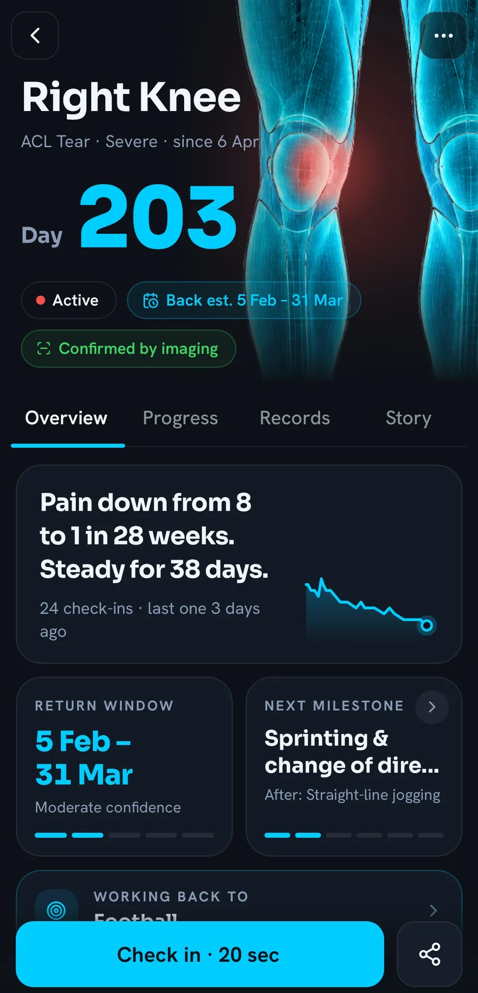 Overview of a right knee ACL tear on day 203: pain down from 8 to 1 in 28 weeks, a return window of 5 February to 31 March with moderate confidence, and the next milestone, sprinting and change of direction.